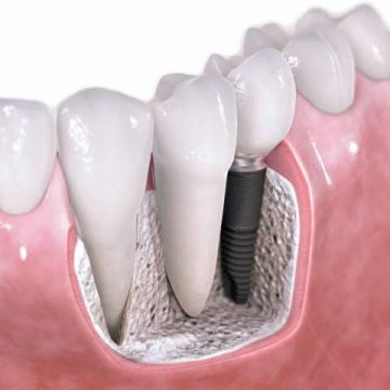 impalnat-diş-görüntüleri-vidalı-diş-nedir